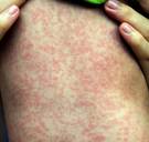 WHO slaat alarm: grootste mazelenepidemie in Europa in tien jaar