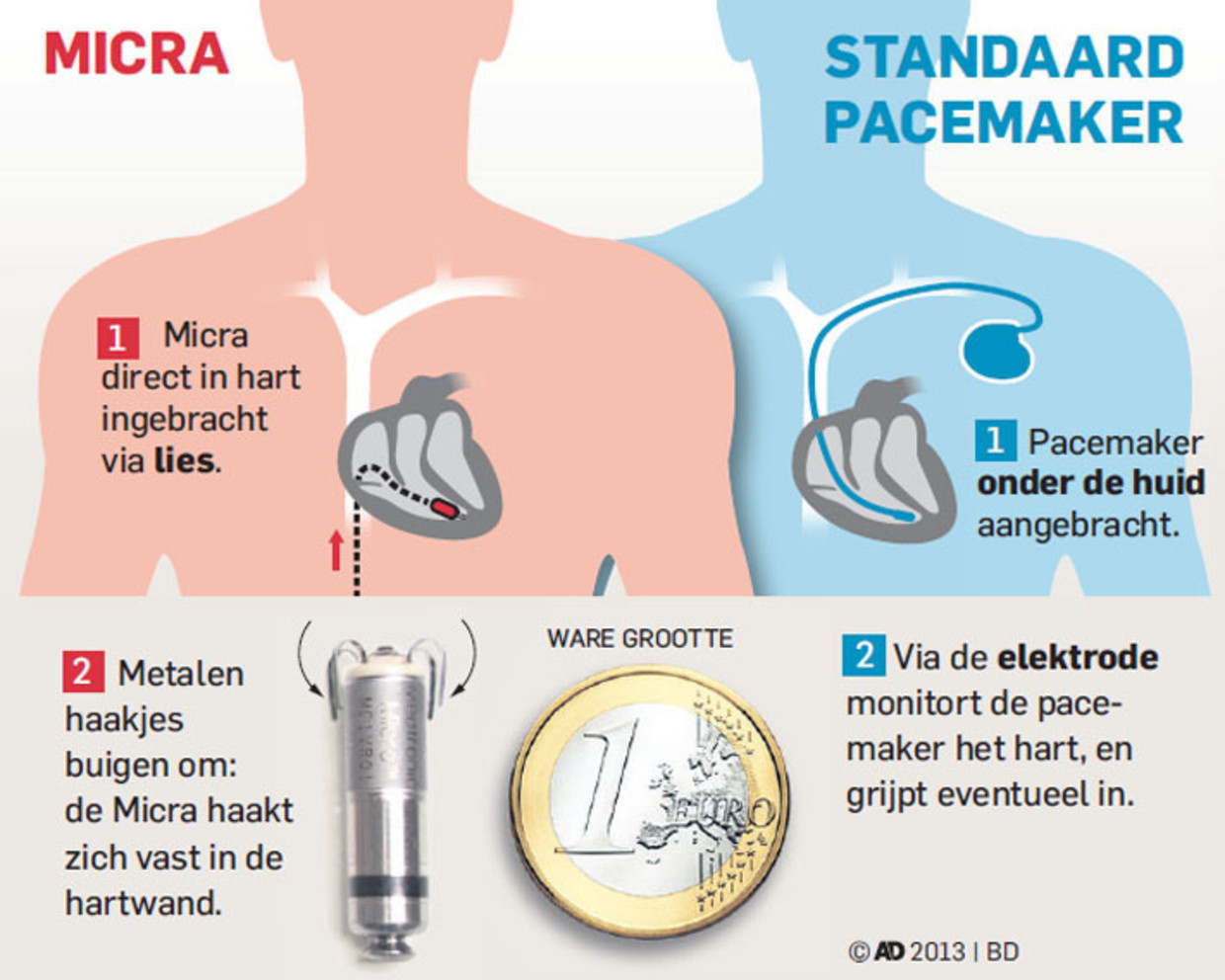 Mini-pacemaker veroorzaakt revolutie in medische wereld | De Morgen
