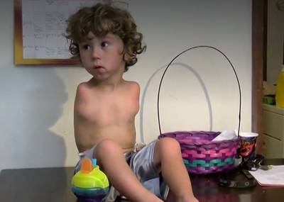 Jongetje zonder armpjes mag niet met voetjes eten in restaurant