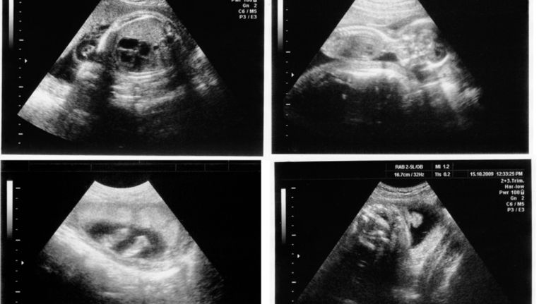 Elke Bevalling Mag In Bad Op Een Kruk Met Kaarsjes Maar Je Kind In Levensgevaar Brengen Dat Mag Niet De Volkskrant