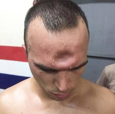 Thaibokser slaat tegenstander met elleboog diepe deuk in voorhoofd