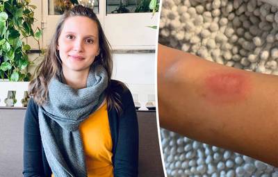 Ellen (25) loopt zware brandwonden op door Fitbit: ‘Ik werd wakker en voelde mijn arm branden’