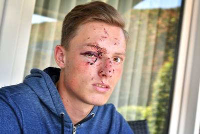 Frank (21) was bijna blind na een glas in zijn gezicht